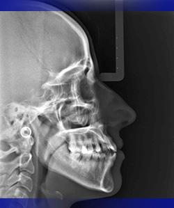 utilizzando questa radiografia si esegue lo studio cefalometrico